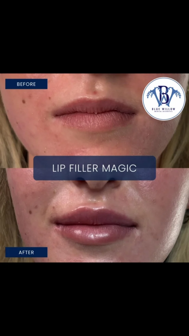 💋 A little lip love goes a long way!

Before ➡️ After ✨

Beautiful, balanced lips with just the right amount of volume and definition! 💙

Our goal is never to change your natural beauty, but to enhance what you already have.

✨ Customized to your facial features
✨ Beautiful shape and definition
✨ Results tailored to your goals

📍 Blue Willow Medical Aesthetics | Baton Rouge, LA

📲 Call or book online at www.bluewillowmedical.com

#LipFiller #BeforeAndAfter #BatonRougeLipFiller #BlueWillowMedicalAesthetics #NaturalLookingLips