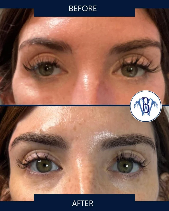 It’s all in the little details! ✨
Temple filler might not be the first treatment that comes to mind, but it can make a beautiful difference! 🩵
By restoring lost volume in the temples, we can create a softer, more balanced, and refreshed appearance while keeping your results natural. 💉
Sometimes the most subtle changes make the biggest impact! 🤍

#bluewillowmedical #templefiller #facialbalancing #naturalresults
