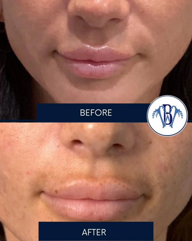 Check out this smile line filler before and after by Eva! 🩵
A little filler, a lot of confidence! 💉
Softening smile lines while keeping your natural beauty front and center. ✨
Our goal? Smoother, refreshed results that still look like YOU! 🙋‍♀️

#smilelines #filler #bluewillowmedical #batonrougemedspa #beforeandafter