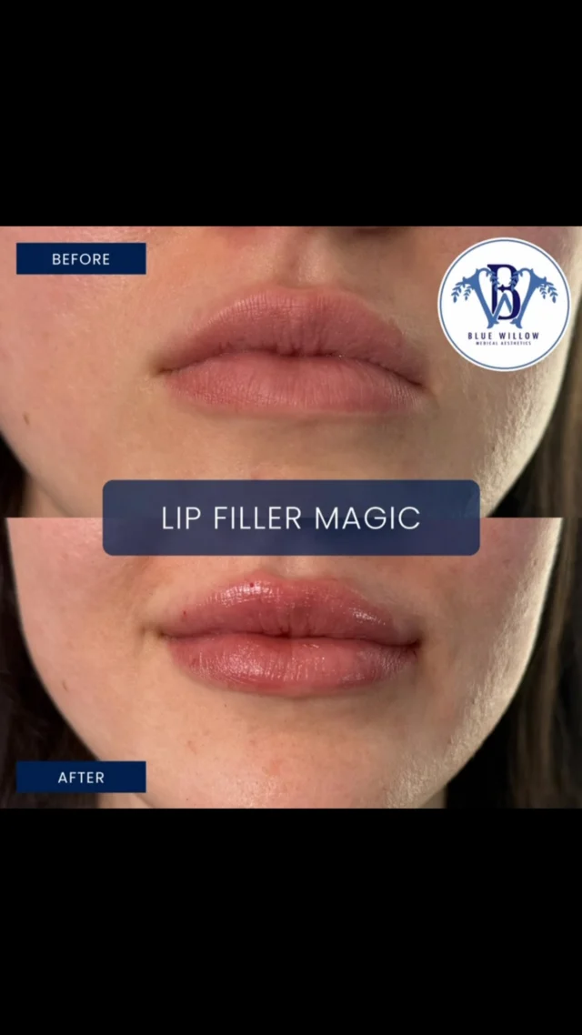 Lip filler magic 💋 Soft, natural volume that still looks like you. Every treatment starts with a conversation, so your results feel authentic, effortless and truly yours.
💋 Don’t miss our monthly specials on lip fillers! 💉
📍 Conveniently located in Baton Rouge off Highland Rd & Magnolia Suites, Central, LA
💻 Book now at bluewillowmedical.com | 📞 Call us at (225) 384-0051 or message us for availability!
💙 Financing options & rewards programs available!
#bluewillowmedical #batonrougemedicalspa #lipfiller #fillerbeforeandafter #dysport